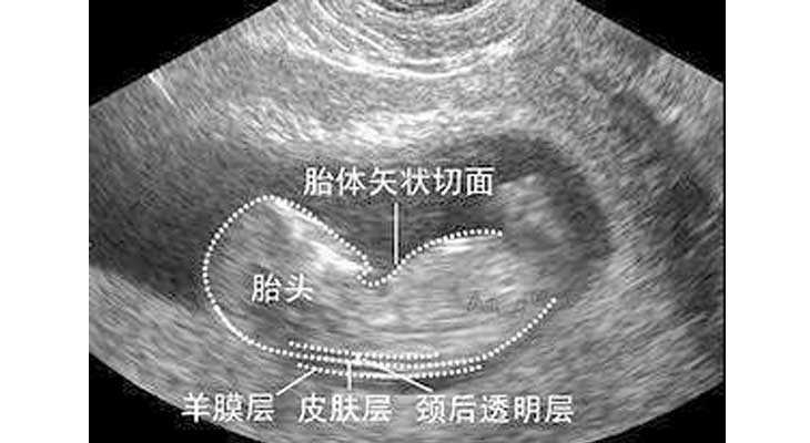子宫切除却怀孕了_子宫切除生育_试管婴儿12周未做NT检查还能补救么